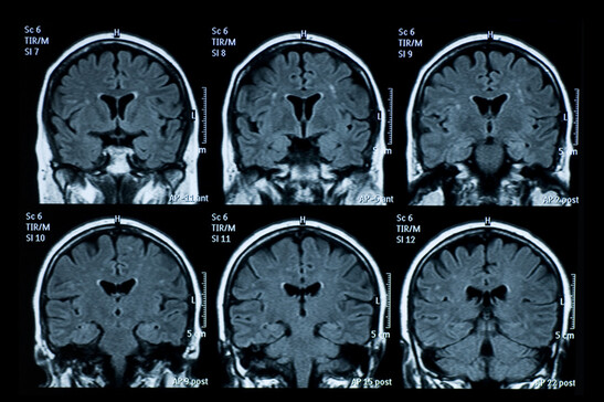 L'ipotesi di un virus per alcuni casi di Alzheimer