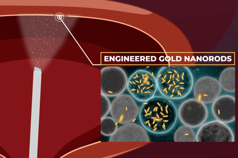 Rappresentazione grafica di un intervento basato sull 'utilizzo di nanoparticelle d 'oro (fonte: IRCCS Ospedale San Raffaele, Youtube) - RIPRODUZIONE RISERVATA