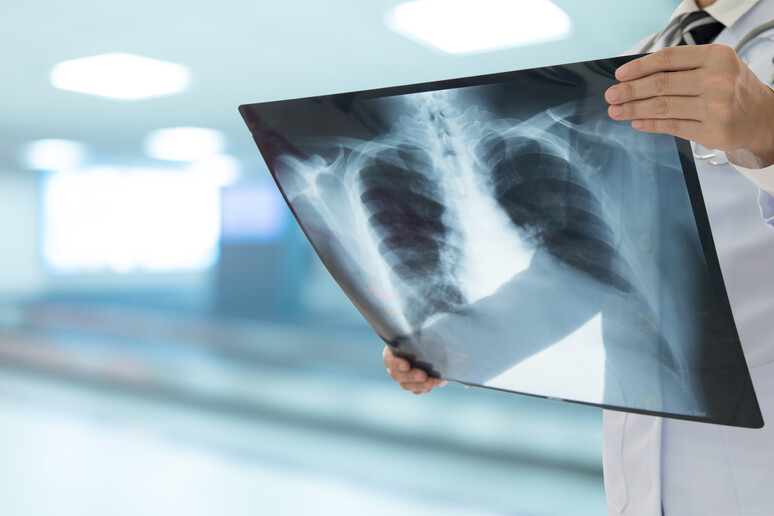 Rx ai polmoni per la diagnosi della Tubercolosi. Attestazione: utah778 - iStock - RIPRODUZIONE RISERVATA